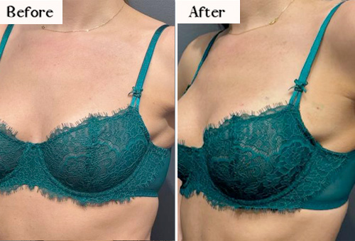 bra dips before and after
